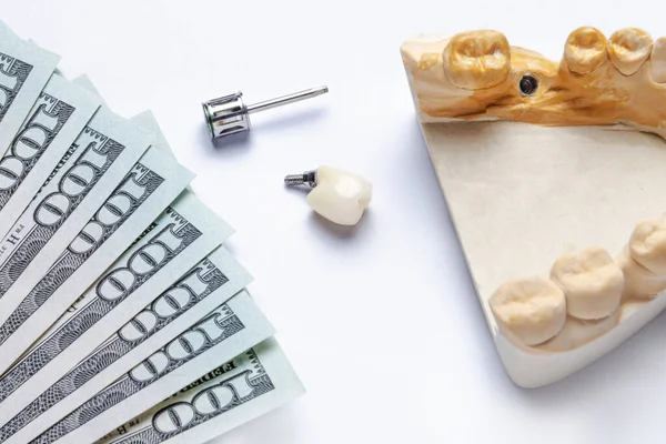 Seramik diş implantı bir diş aleti ve beyaz arka planda implant olan bir diş modeliyle yapılır. Dişin solunda dolar banknotları var. Diş hekimliğinin ve sigortanın yüksek maliyeti kavramı. Dişçilik için para toplamak
