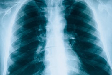 Ciğerlerinin röntgenleri. Florografi. Hastanedeki akciğerleri kontrol ediyorum. Gerçek x-ray insan akciğerleri.