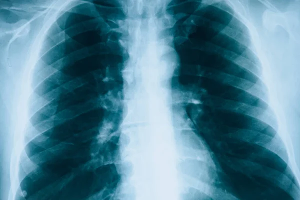 Rays Lungs Fluorography Checking Lungs Hospital Real Ray Human Lungs — Stock Photo, Image