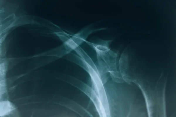 Radiographie Épaule Image Radiographique Articulation Épaule Clavicule Cassée Humains — Photo