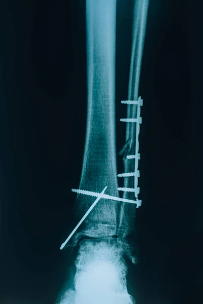 Ray Snapshot Leg True Ray Leg Joint Pins Fixing Bolts — Stock Photo, Image