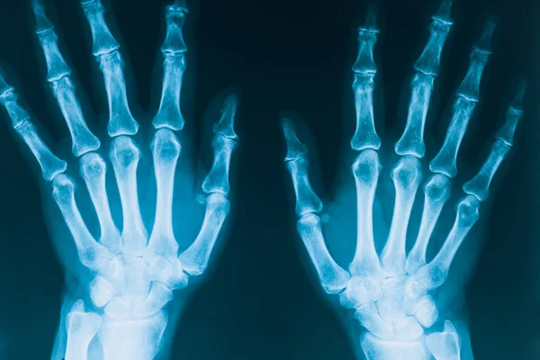 X-ray of hands. Real x-ray picture of hands, two hands in projection. Human bones. Medical concept.