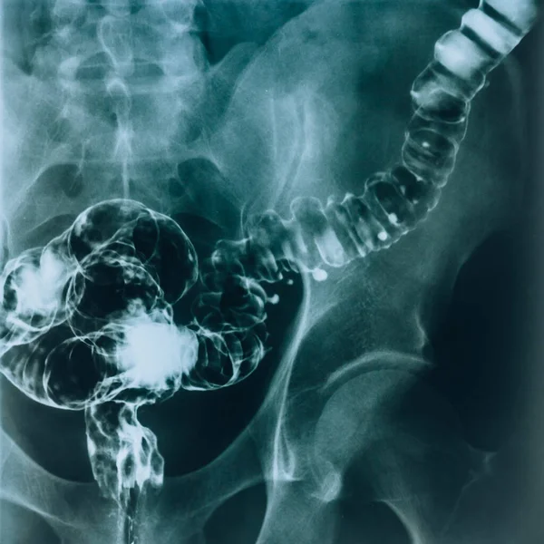 Bağırsağın Röntgeni Hastalıklı Bir Bağırsağın Radyolojik Muayenesi — Stok fotoğraf