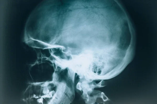 Radiographie Crâne Rayon Tête Vue Latérale Des Humains Chez Médecin — Photo