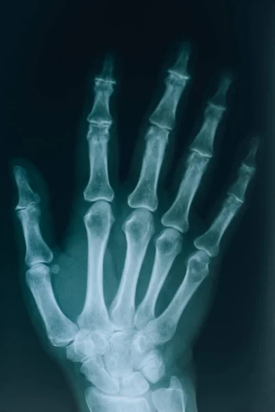 Ellerin Röntgeni Parmakları Olan Bir Elin Gerçek Ray Resmi Doktor — Stok fotoğraf