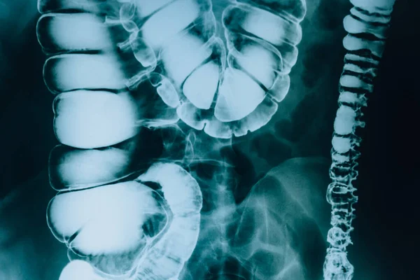 Radiographie Intestin Cette Radiographie Est Instantané Des Organes Internes Système — Photo