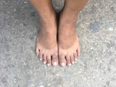 Güneş yanığı ayakkabı kalktıktan sonra çıplak ayak izi.