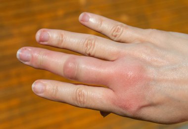 a right hand after a bee bite, swelling hand, swollen finger, hand after a bee sting