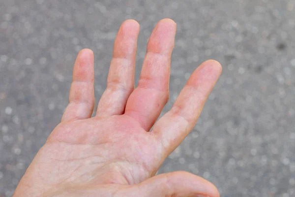 a right hand with a bee, wasp bite mark, swelling hand, swollen finger, hand after a bee sting, bite