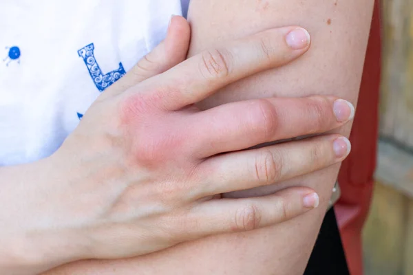 a right hand after a bee, wasp bite, swollen hand lyes on a right arm 