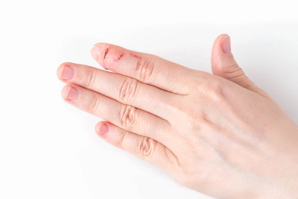 a left hand index finger with sores and scars after injury, tip of the finger bending downwards while the rest of the finger stay straight, deformity in the last phalangeal bone