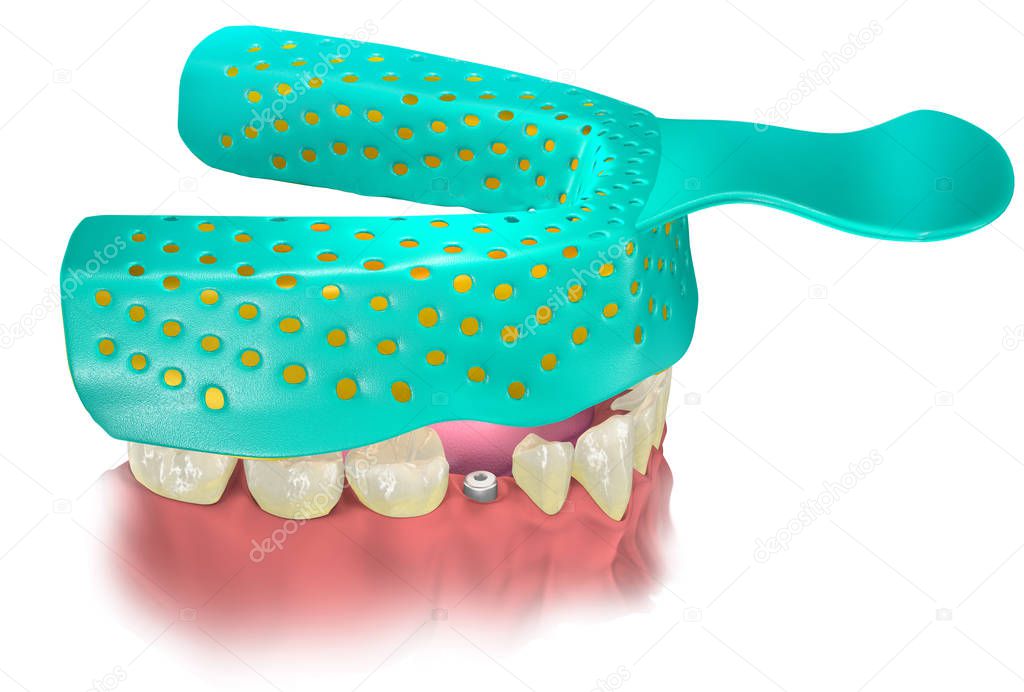 Impression Tray with Impression material putting on lower jaw with healing cap on the place of missing tooth. Close tray procedure. 3D illustration.
