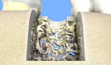 Bir insanın alt çenesini deldikten sonra delik açıldı. Mavi arka planda kortikal ve yoğun kemikler. 3d illüstrasyon.