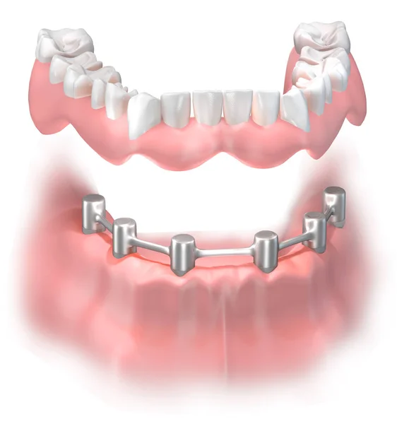 Attachment False Denture Lower Jaw Help Titanium Bridge Fixed Implants — Stock Photo, Image