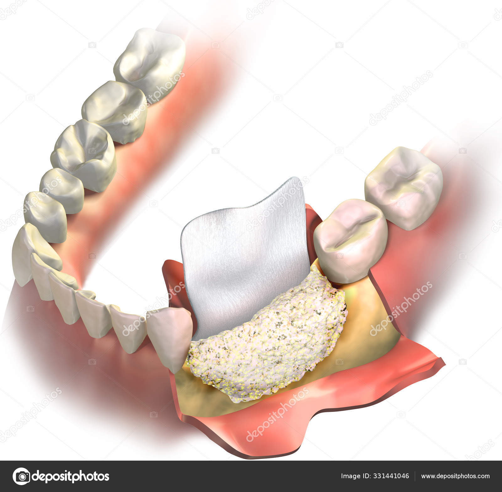 Dental Barrier Regenerative Collagen Membrane Putting Cutted Gums Bone