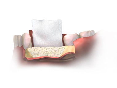 Büyütme Cerrahisi 'nin dikey kemik yenileme prosedürü. Kapatın, alın manzaralı kemik nakli ve rejeneratif kolajen diş zarı greftin üzerinde bükülmeden önce. 3d illüstrasyon.