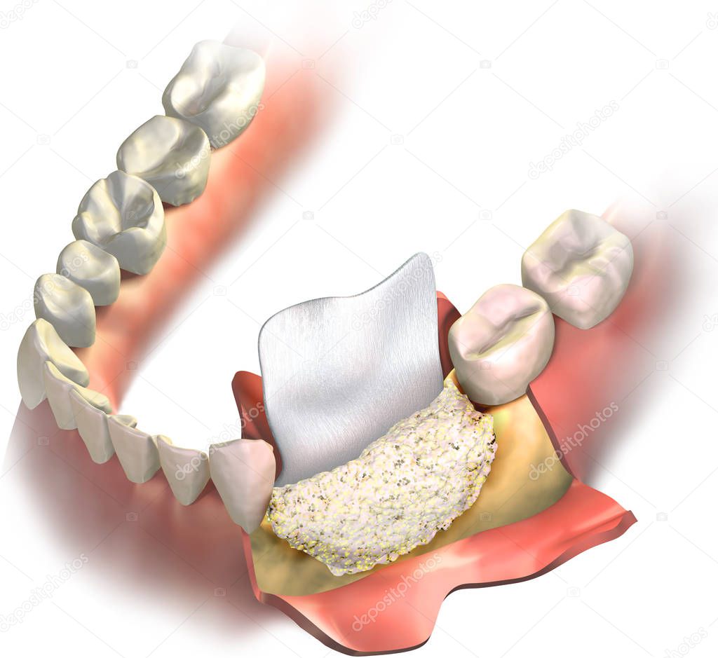 Dental barrier regenerative collagen membrane putting between cutted gums and bone graft, that part of vertical bone regeneration procedure. 3D illustration of Augmentation Surgery.