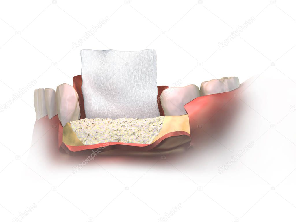 Vertical Bone regeneration procedure of Augmentation Surgery. Close up, frontal view bone grafting and regenerative collagen dental membrane before warping above a graft. 3D illustration.