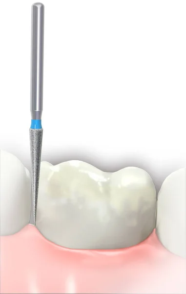 Förbereda Forma Framtanden Tand Med Diamant Dental Burs Vit Bakgrund — Stockfoto