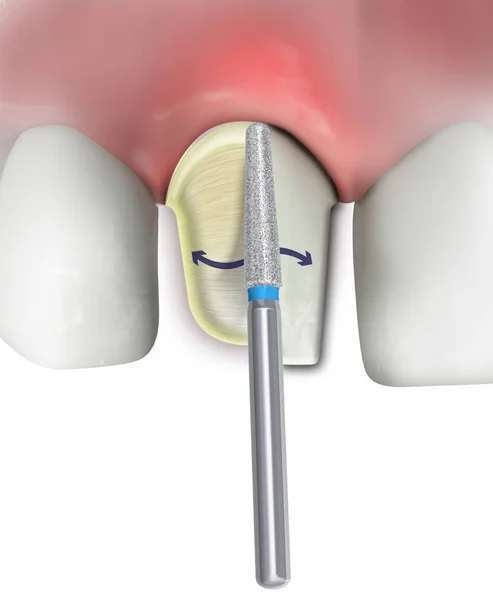 Przygotowanie Kształtowanie Zęba Siekacza Diamentowymi Zaciskami Dentystycznymi Białym Tle Ilustracja — Zdjęcie stockowe