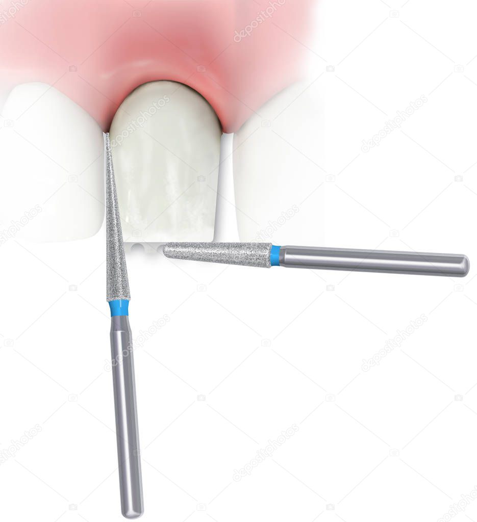 Preparing (shaping) the incisor tooth with diamond Dental Burs on white background. 3D illustration.