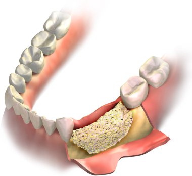 Bone graft placed on Loss bone in lower jaw before close it with gums. Vertical Bone regeneration procedure. 3D illustration. clipart
