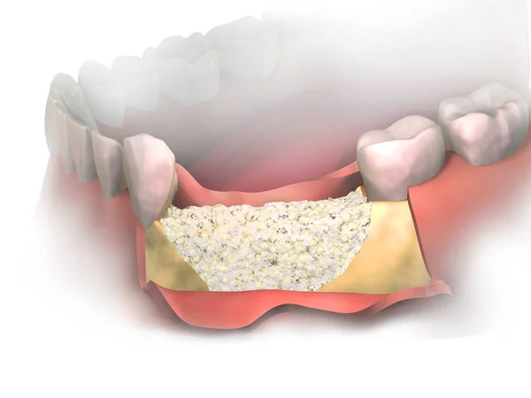 下颌骨摘除后 在下颌骨增加新的骨丢失 骨移植放置在前视图 在植入骨膜之前 3D例证 牙龈增生手术 — 图库照片