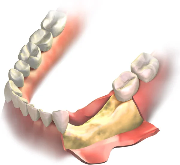 Knochenschwund Unterkiefer Mit Geöffnetem Zahnfleisch Vor Der Operation Mittels Knochentransplantat — Stockfoto