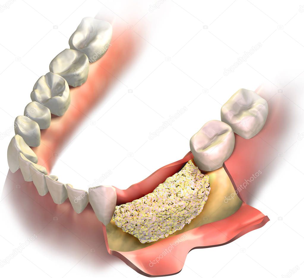 Bone graft placed on Loss bone in lower jaw before close it with gums. Vertical Bone regeneration procedure. 3D illustration.