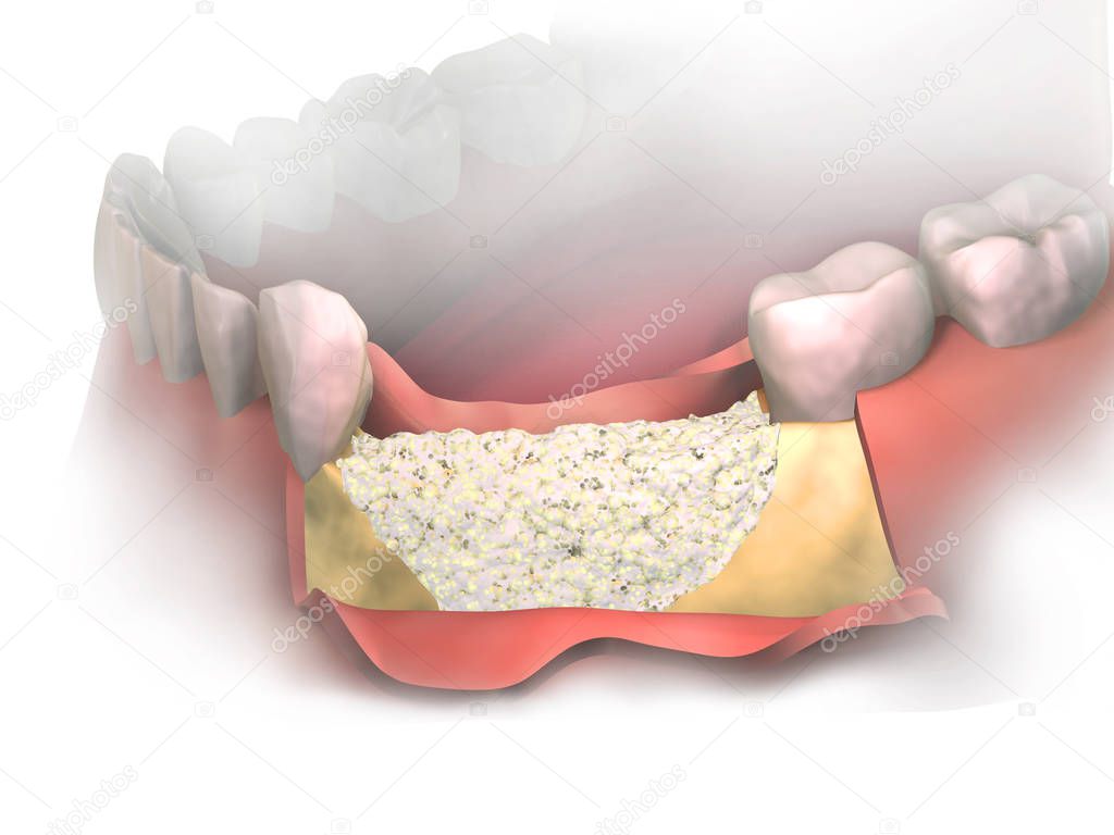 Adding new bone to Bone Loss on lower jaw after tooth removal.  Bone grafting placement in front view. Before putting Membrane on bone graft. 3D illustration. Dental Augmentation Surgery.