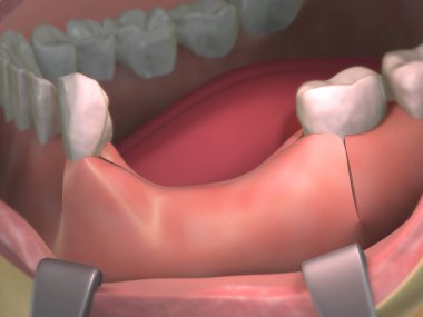 Diş alındıktan sonra kemik kaybı ya da kayıp. İmplantları yerleştirmeden önce kemik hazırlıyorum. Birinci adım, diş etlerini kesmek. Tıbbi 3d illüstrasyon.