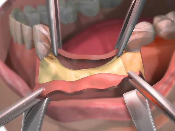 Benförlust Efter Tandborttagning Öppnade Tandköttet Före Operation Med Bentransplantat Benregenerering — Stockfoto