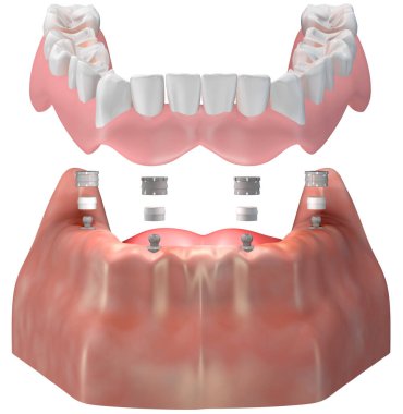 Top ekleme üst yapısı çıkarılabilir bir protezi güvence altına almak için tasarlanmıştır. Eklenti paslanmaz çelik kapak ve ara silikon ekleme ile birlikte kullanılır. Tıbbi 3d illüstrasyon.