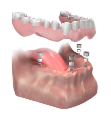Top Abutment kurulumu. Alt İmplant tamamen çıkarılabilir protezi destekledi. 3d illüstrasyon.