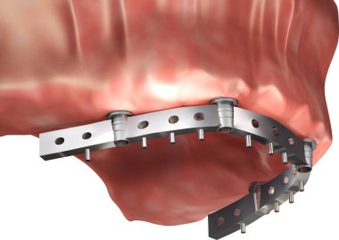 Diş köprüsü, titanyum, üst kemerde diş implantı takılıyor. İmplant eklentisi. 3d illüstrasyon.