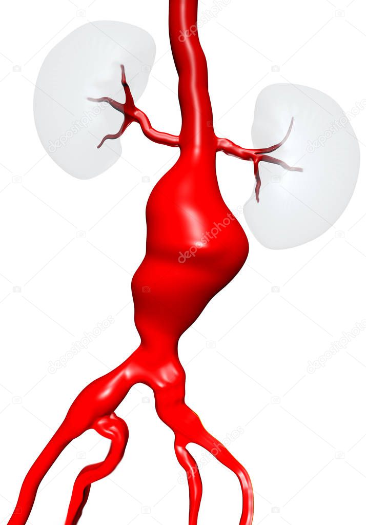 Abdominal aortic aneurysm (AAA) located below the arteries that supply blood to the kidneys. 3D illustration.