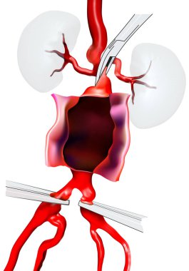 Open surgery for Abdominal Aortic Aneurysm (AAA) located below the renal arteries that supply blood to the kidneys. Aorta are opened, before insert  a graft. 3D illustration. clipart