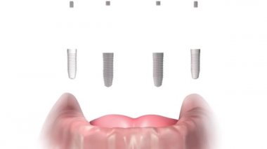 Şema animasyonu, top eklentisinin hangi bölümlerden oluştuğunu gösteriyor. Alt Çene Eksiksiz Takma Diş, Topuk Ayağına ve Silikona sürülüyor. Hepsi de 4 diş implantında. Sakız dokusu şeffaftır. Alt çene çıkarılabilir protez.