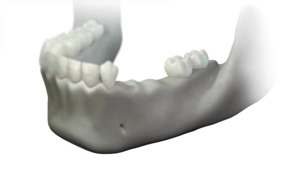歯が失われた場所で 下顎の骨の地盤沈下のアニメーション 歯茎のない骨の損失 骨移植と骨再生を用いた手術が必要です 3D歯科 — ストック動画