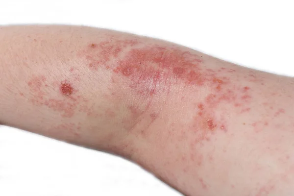 Red Itchy Eczema Rash Elbow Teenage Boy — Stock Photo, Image