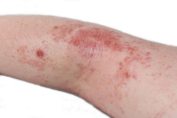 Red, itchy eczema rash on the elbow of a teenage boy.