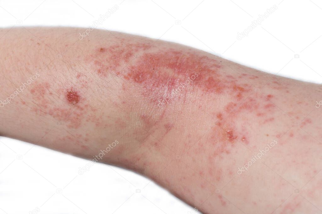 Red, itchy eczema rash on the elbow of a teenage boy.
