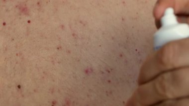 Doktorların elleri tüpten ilaç kremi sıkar ve akne ile cilde uygulanır. Bir damla merhemi nazikçe kırmızı sivilce sivilcesine sürüp deriye sürterek. 4k Uhd video kaydı