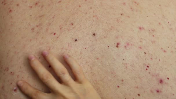 医者は人間の背中の問題のある皮膚に少量の薬のクリーム軟膏を塗り赤と白のにきびとすべての上のラグ Uhd 4Kビデオ映像 — ストック動画