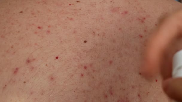 Primer Plano Piel Mujer Del Hombre Con Dermatitis Por Acné — Vídeos de Stock