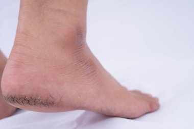 Beyaz arka planda siyah kötü derili kuru ve çatlak topuk yakın plan. Reklam konsepti için tıbbi ve sağlık hizmeti.