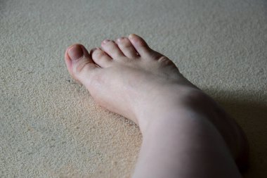 Bacak tekmelenmiş ve ayak bileği şişmiş. Güzel bacaklı bir tümsek.