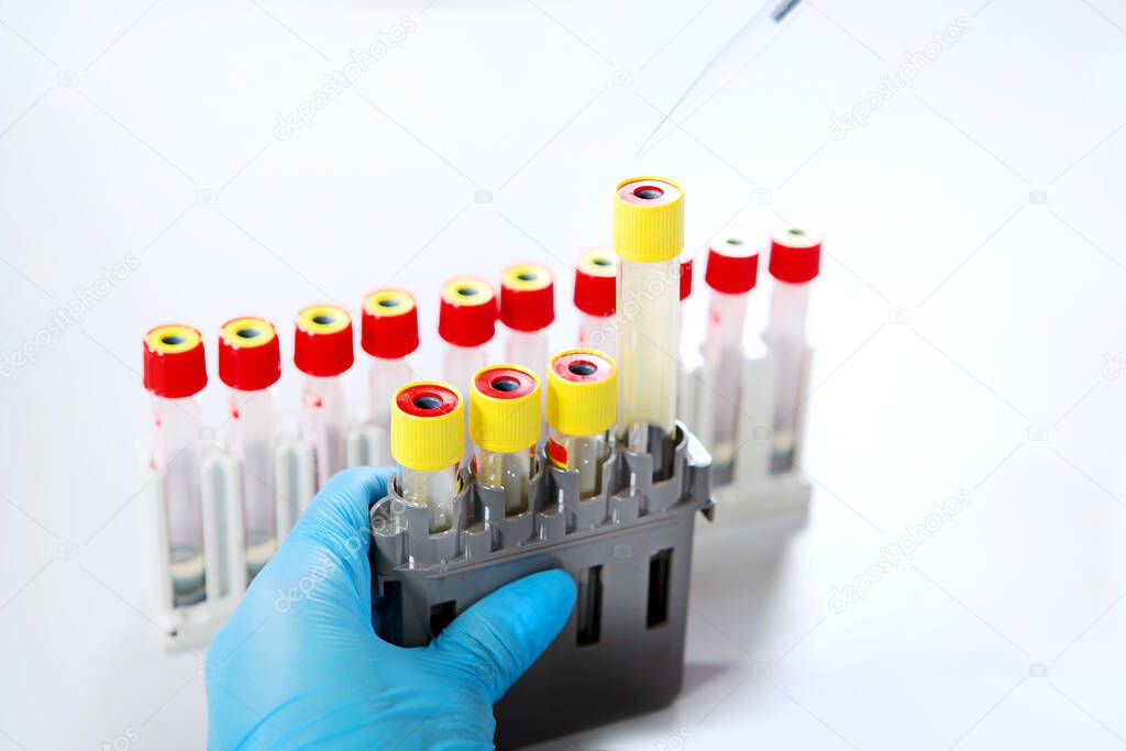 A gloved hand holds medical tubes and a pipette.. 2019-nCoV. Chemical analysis studies. The threat of a coronavirus epidemic.Copy of pace. Out of focus. Top view