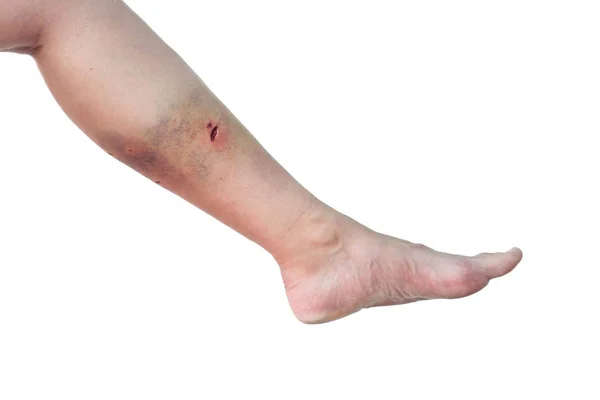 Нога Белой Женщины Собачьим Укусом Икру Изолированном Белом Фоне Женская — стоковое фото