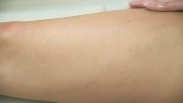 Masaje Vacío Celulitis Para Una Mujer — Vídeo de stock